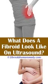 can fibroids cause weight gain