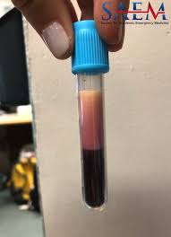 Image result for Hypertriglyceridemia