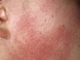 What you describe could certainly include many possible pathologies and inflammatory processes in the differential, including keratosis pilaris. Keratosis Pilaris Dermnet Nz