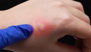 Adam bildiğin on numara hödük ama herkesler ağzının suları akarak izliyor herifi. Skeeter Syndrome Treatments And Home Remedies