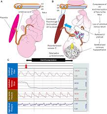 Image result for Delayed Transition from Fetal Circulation