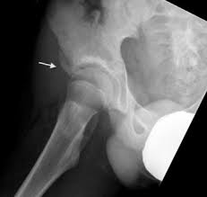 Our pelvic floor physical therapists treat men, women and children for pelvic floor dysfunction. Anterior Inferior Iliac Spine Avulsion Aiis Knee Sports Orthobullets