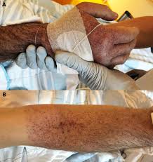 Large extravasation of blood into the skin is known as ecchymosis. Petechial Purpuric Rash After Non Invasive Blood Pressure Measurement Rumpel Leede Sign Bmj Case Reports