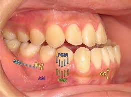 Image result for Gingiva