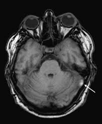 Microvascular Ischemia An Overview Sciencedirect Topics