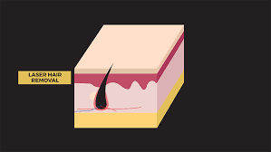 It had been performed experimentally for about twenty years before becoming commercially available in 1995 and 1996. Laser Hair Removal O Medical Clinic