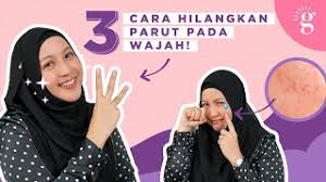 Mengubati parut jerawat biasanya bergantung kepada tahap dan lokasi parut anda. 3 Cara Hilangkan Parut Jerawat Pada Wajah Youtube