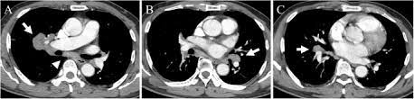 Lung cancer should be excluded to confirm a diagnosis of sarcoidosis  4 , although the concurrence of sarcoidosis and lung cancer has been reported  5, 6, 7, 8 . Delayed Diagnosis Of Lung Cancer Due To Misdiagnosis As Worsening Of Sarcoidosis A Case Report Bmc Pulmonary Medicine Full Text