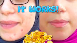 The form of vitamin e: Vitamin E Transformation To Permanently Cure Acne Omg The Results Youtube