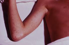 Maybe you would like to learn more about one of these? Rocky Mountain Spotted Fever Rmsf Infections Msd Manual Consumer Version