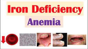 Blood tests reveal microcytic, hypochromic anaemia; Iron Deficiency Anemia Overview Causes Pathophysiology Signs Symptoms Diagnosis Treatment Youtube