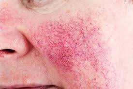 Image result for red rash face