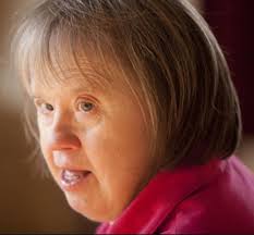 Course of Alzheimer Disease in People with Down Syndrome