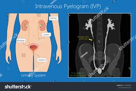 Image result for Intravenous Pyelogram