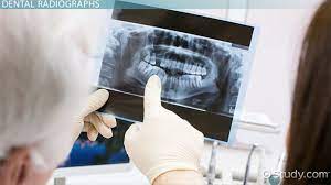 Basic Terminology Of Dental Radiography - Video & Lesson Transcript |  Study.com