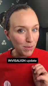 Adult Braces Progress Update: Invisalign Journey