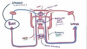 L'aorte part anormalement du ventricule droit et l'artère pulmonaire du ventricule gauche. Transposition Des Gros Vaisseaux Wikipedia