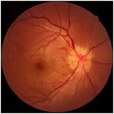 Image result for Neurosyphilis