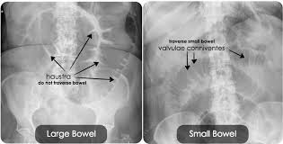 Rosh Review Medical School Stuff Medical Mnemonics Large Bowel