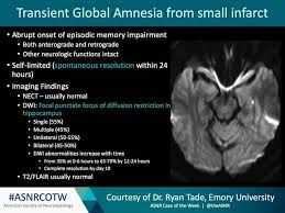 Image result for Transient Global Amnesia