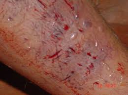 A common sign of a bite from a venomous snake is the presence of two puncture wounds from the animal's fangs. Traditional First Aid In A Case Of Snake Bite More Harm Than Good Bmj Case Reports