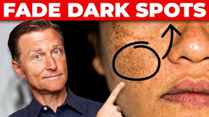 Conquer Acne With Dr. Huma Afzal!