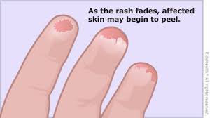 Image result for Scarlet Fever