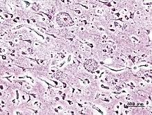 Memory Disorder Wikipedia