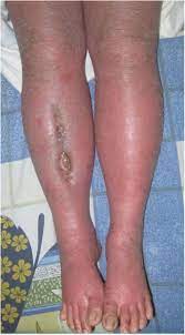 Hypersensitivity To Orthopaedic Implant Manifested As Erythroderma Timing Of Implant Removal Sciencedirect