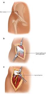 Image result for Obturator Nerve Compression