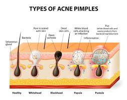 Image result for Nodule