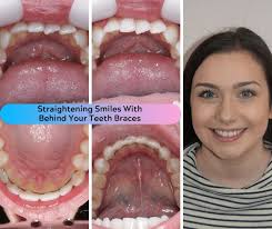 Behind Teeth Braces