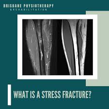 Image result for Tibia Stress Fracture