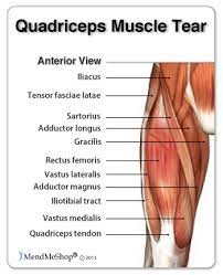 Treatment for a pulled quad muscle can be divided into two phases. Quadriceps Muscle Strain