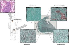 Typical Microscopic Observation Of Tumor Heterogeneity Osteosarcoma Is Download Scientific Diagram