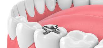 Maybe you would like to learn more about one of these? Apa Itu Dental Amalgam Berikut Fakta Dibaliknya Fdc Dental Clinic