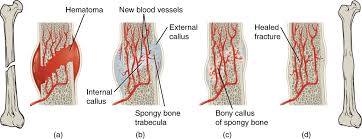 The Healing Of A Bone Fracture Follows A Series Of Progressive Steps A A Fracture Hematoma Forms B Intern Anatomy And Physiology Bones Types Of Fractures