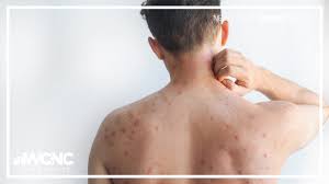 Image result for Measles