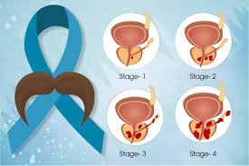 Image result for Prostate Cancer Staging