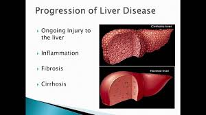 It is not possible to prevent a1ad, as it is an inherited disease. Alpha 1 Antitrypsin Deficiency 101 Liver Youtube
