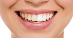 We did not find results for: Teeth Whitening Services What You Need To Know Cosmetic Dentistry