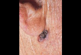Certain other types of cancer, including … Skin Cancer Picture Image On Medicinenet Com