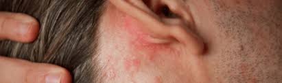 For the past three years, i have been on an endless search from doctor to doctor, blood tests, skin biopsies to no avail. How To Identify Treat Heat Rash Gohealth Urgent Care