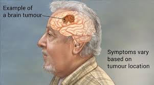 Brain Tumor Brain Tumor Tumor Brain Tumor Symptoms