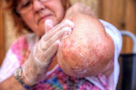 How to treat diabetic dermopathy lesions. Type 2 Diabetes And Skin Health Which Skin Conditions Are Linked