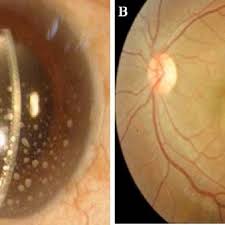 Uvea is the biggest pigmented part of your eyes; Swelling Of The Uvea A Eye With Anterior Uveitis B Eye With Download Scientific Diagram