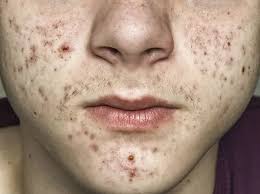 Imagens de Adolescente com acne sem royalties | Depositphotos