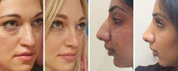 While the nose job before and after results achieved by dr bashar is scarless and worth trying. Rhinoplasty Before And After Uk Wide Nose Bulbous Rounded Nasal Tip Photos