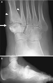 Imaging Of Infection In The Diabetic Foot Springerlink
