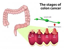 Learn about the signs and symptoms of colorectal cancer such as blood in the stool, a change in colorectal cancer might not cause symptoms right away, but if it does, it may cause one or more of rectal bleeding with bright red blood. Colorectal Cancer Symptoms Treatment Risk Factors And More
